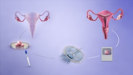 What is IVF?