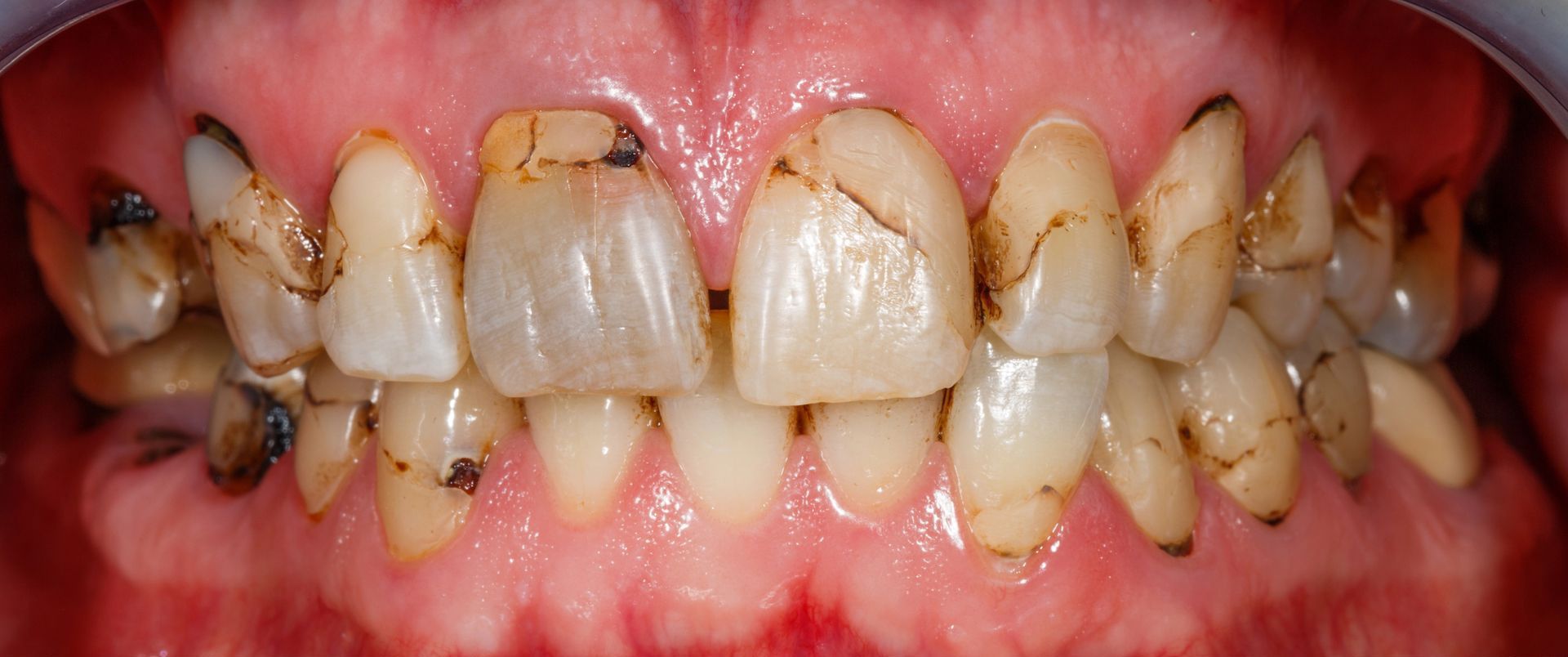 Before Image of a Smile with Damaged Teeth