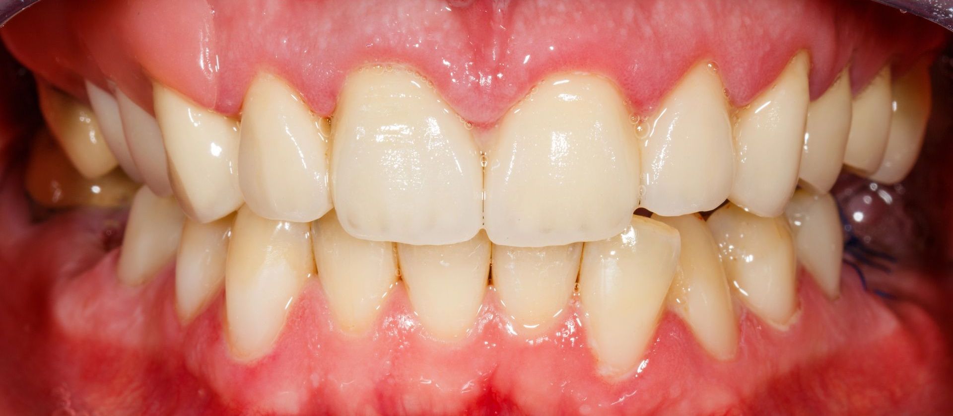 After Image of a Smile with Fixed Teeth