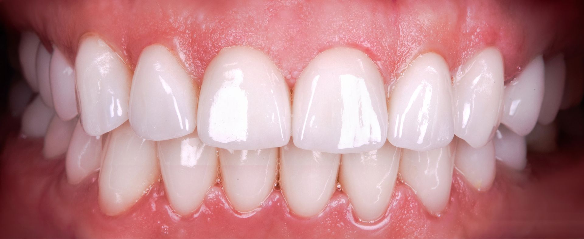 After Image of a Smile with White Teeth