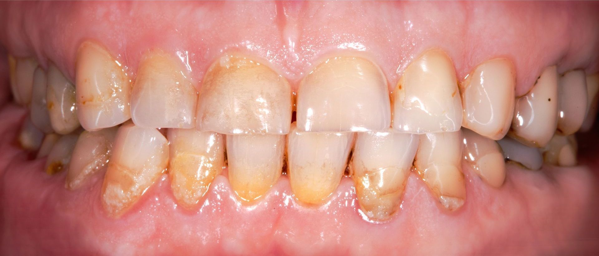 Before Image of a Smile with Stained Teeth