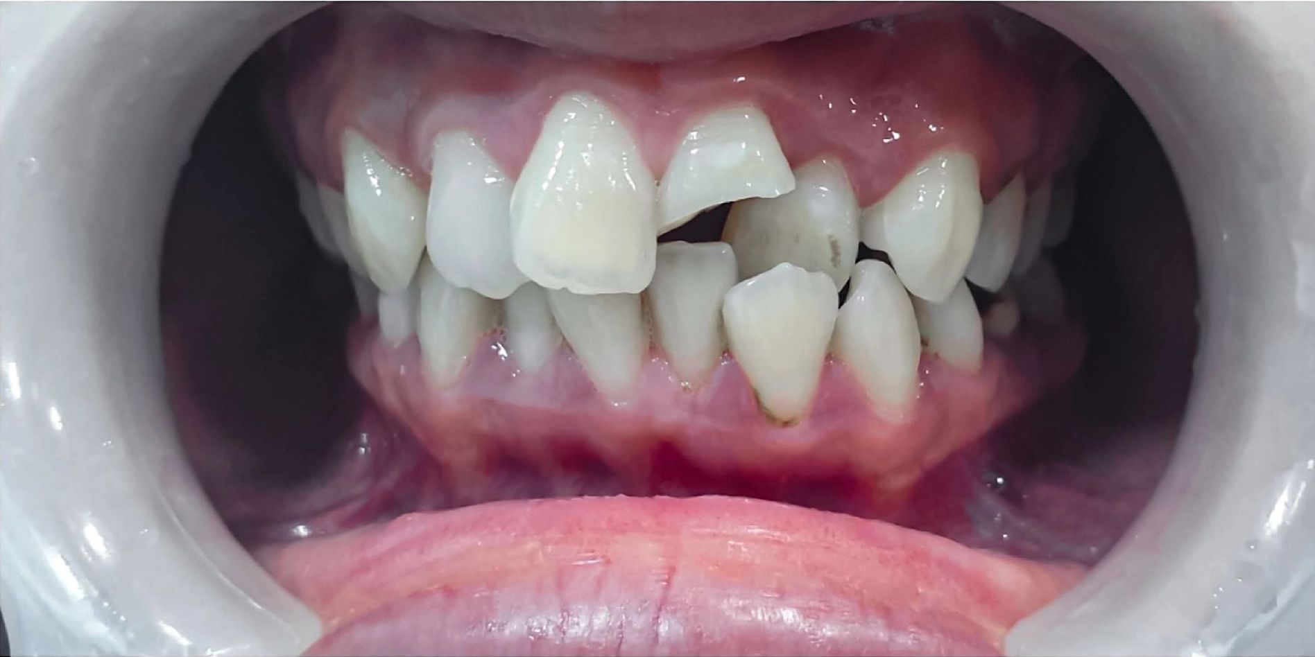 Before Image of Smile with a Broken Tooth