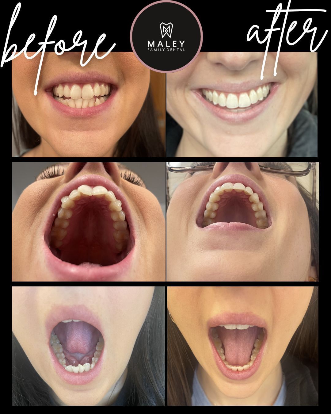 Before and After Photos of SureSmile Treatment at Maley Family Dental