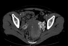 Syndrome de congestion pelvienne avec varices pelviennes en relation avec un nutcracker syndrom.