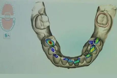 A digital 3D model of a lower jaw with colored areas highlighting teeth, likely for dental analysis.