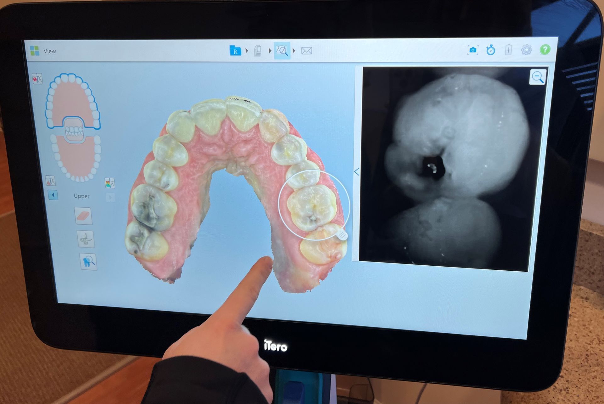 A person points to 3D dental scan on a monitor, next to an X-ray of a tooth.