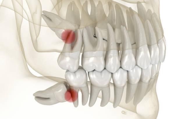 X-ray view of a jaw showing impacted wisdom teeth highlighted in red, indicating pain or infection.