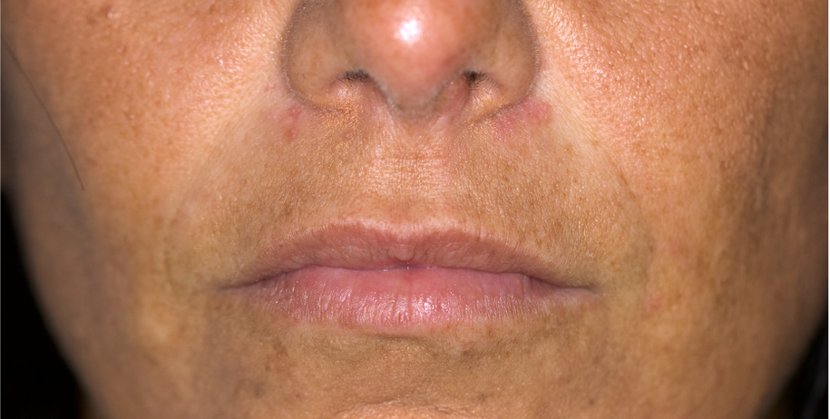 harmonização orofacial antes e depois