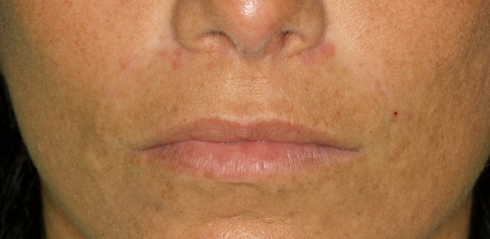 harmonização orofacial antes e depois