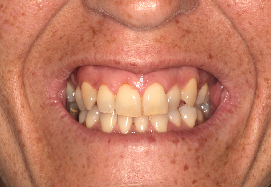 harmonização orofacial antes e depois