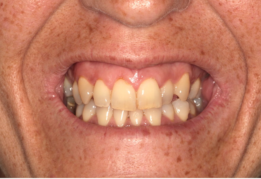 harmonização orofacial antes e depois