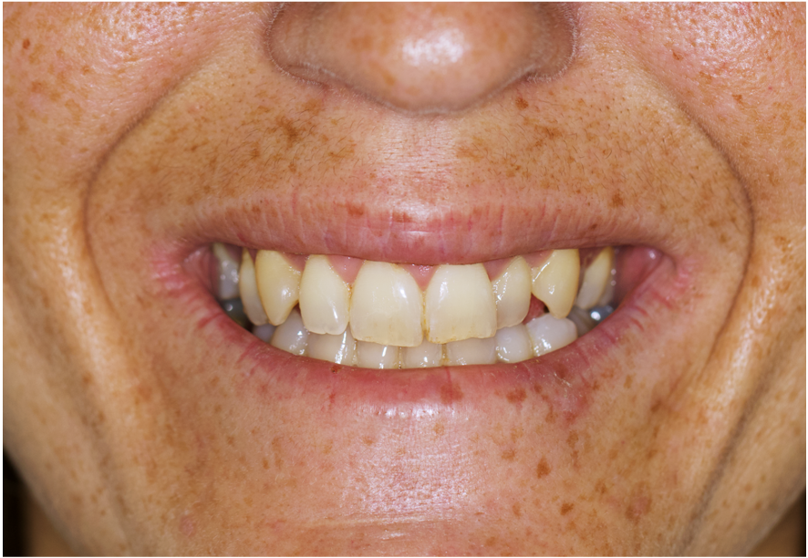 harmonização orofacial antes e depois