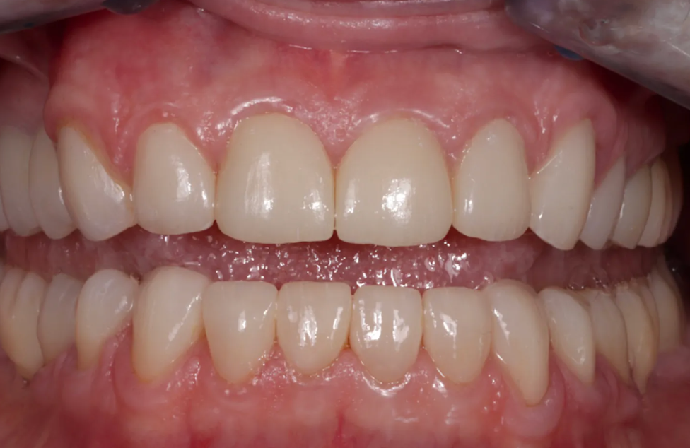 coroas dentárias antes e depois