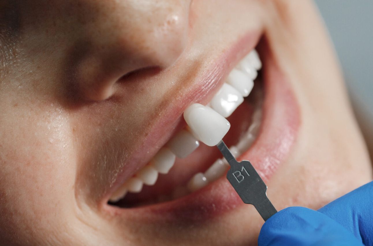 Resultados do tratamento de facetas dentárias.