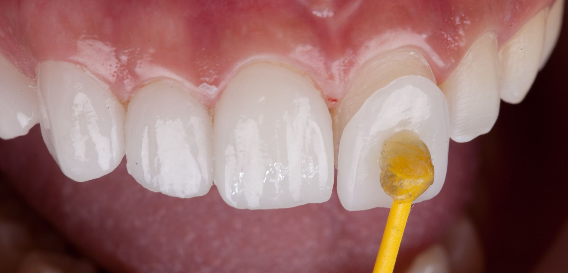 colocação de facetas dentarias