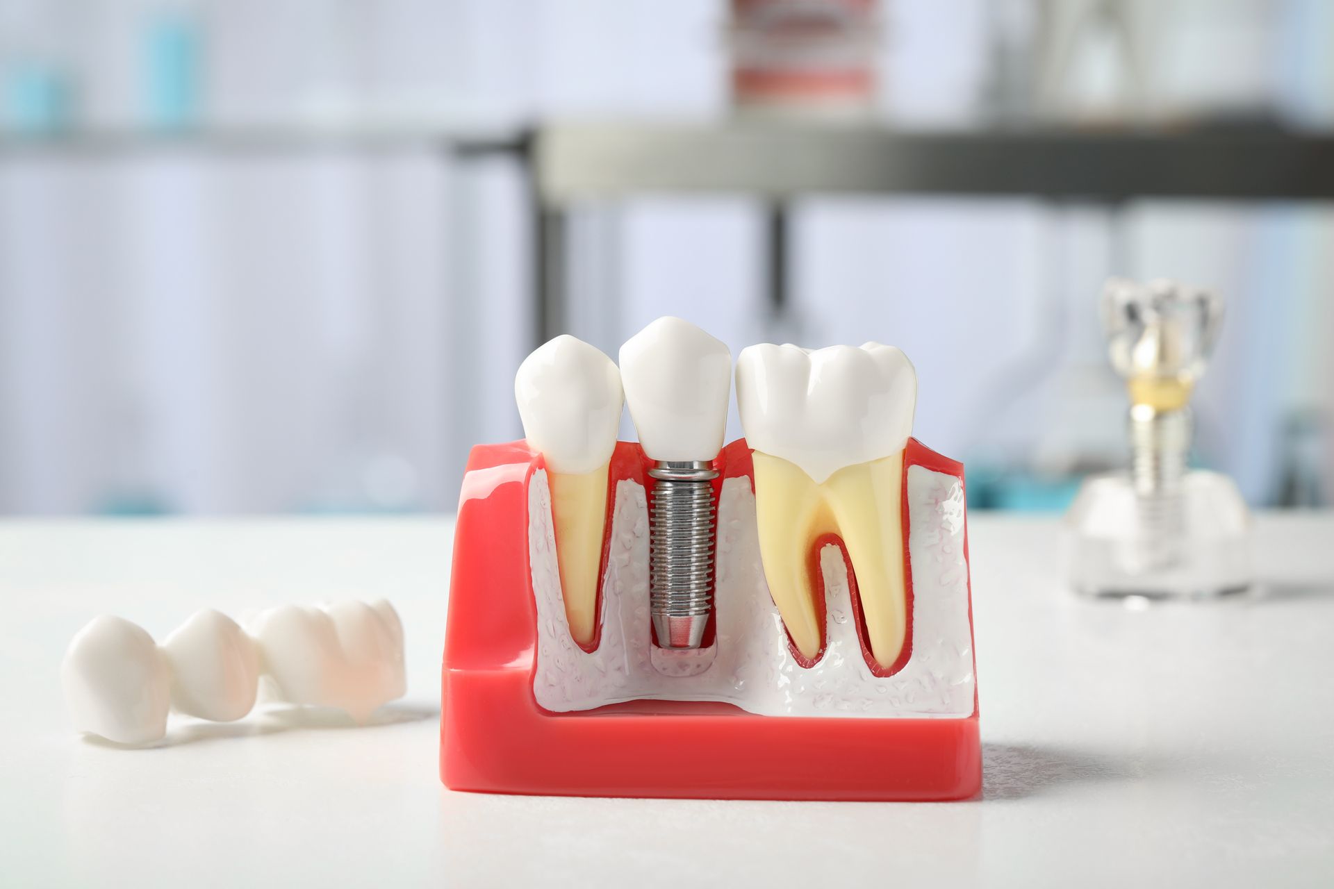 Molde para exemplificar a colocação de implantes dentários.