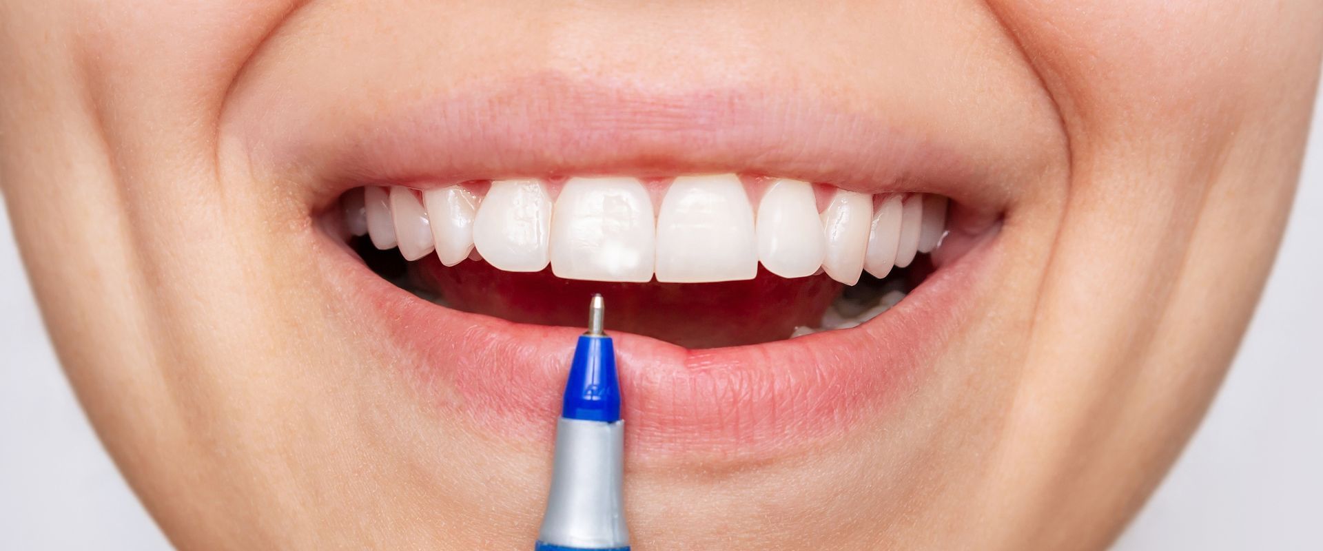 manchas nos dentes ou fluorose dentária