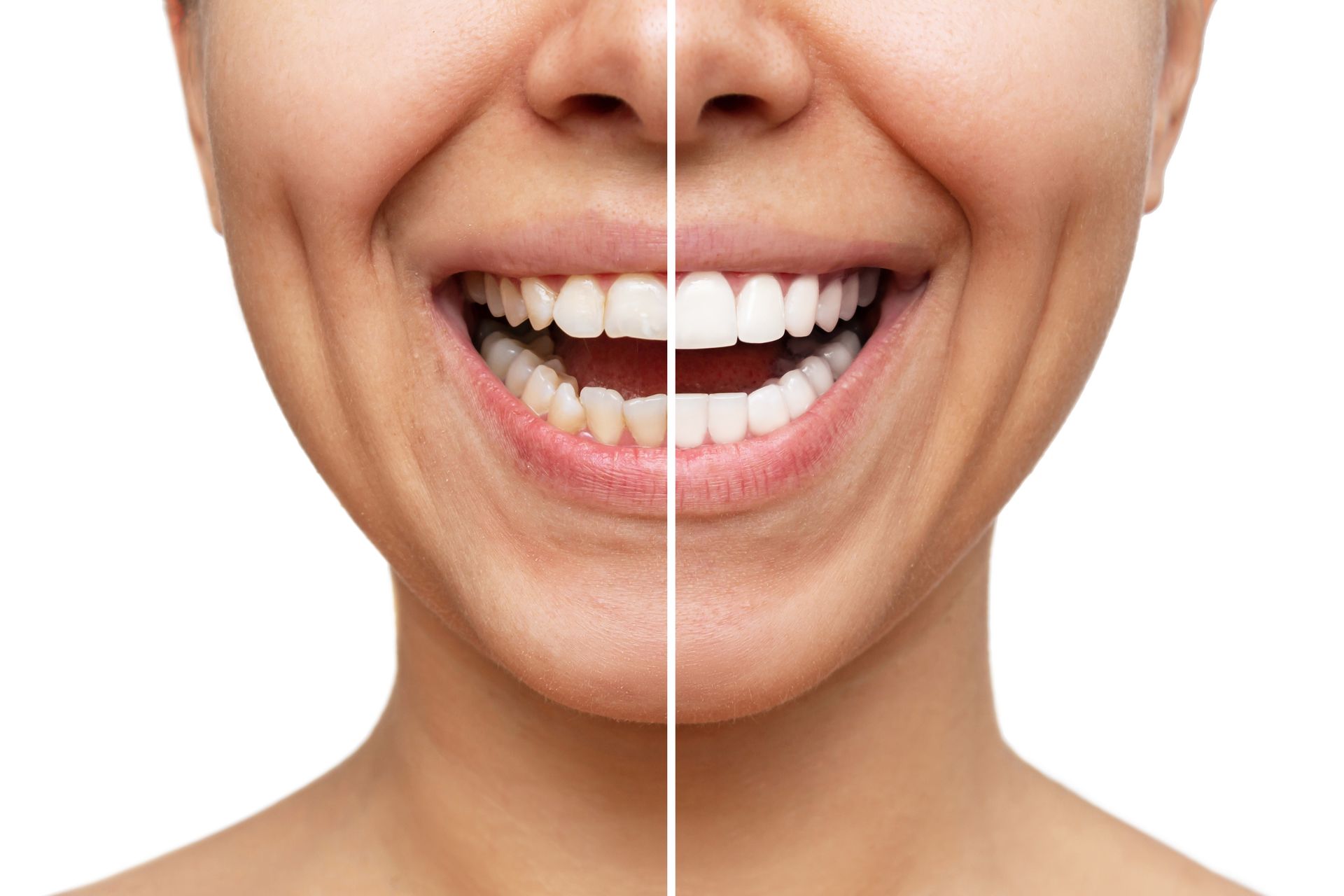 Resultados do tratamento de facetas dentárias.