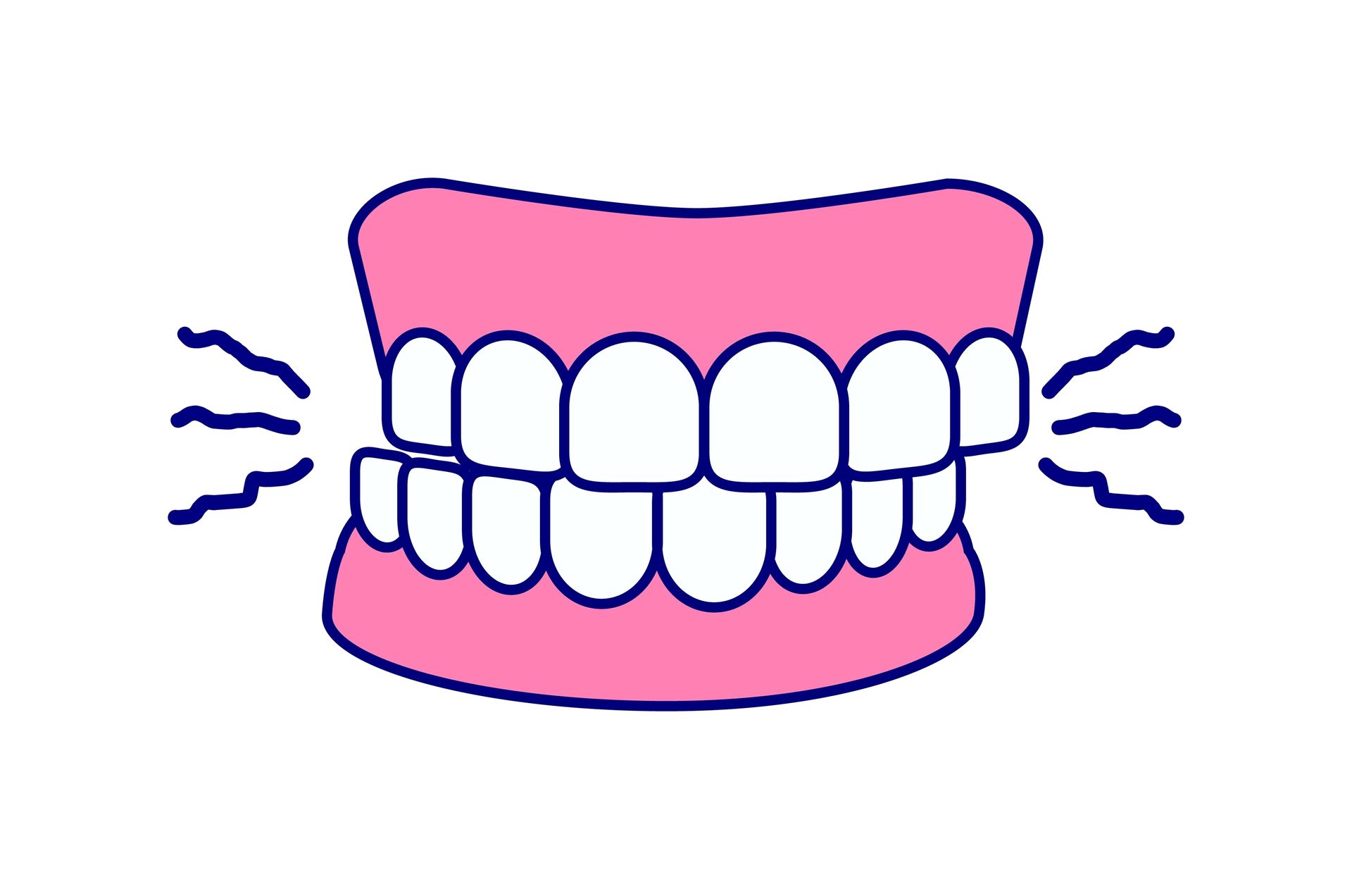Apertar e ranger os dentes são sintomas do bruxismo.