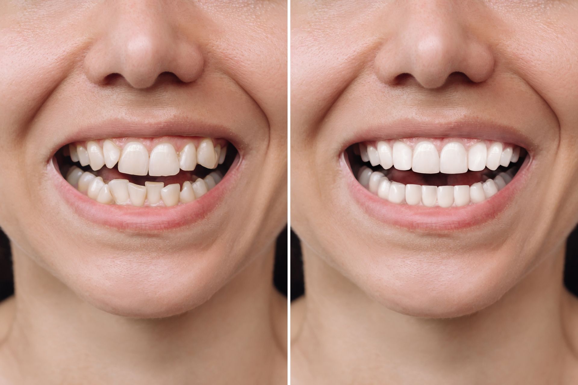 antes e depois de colocar facetas dentárias