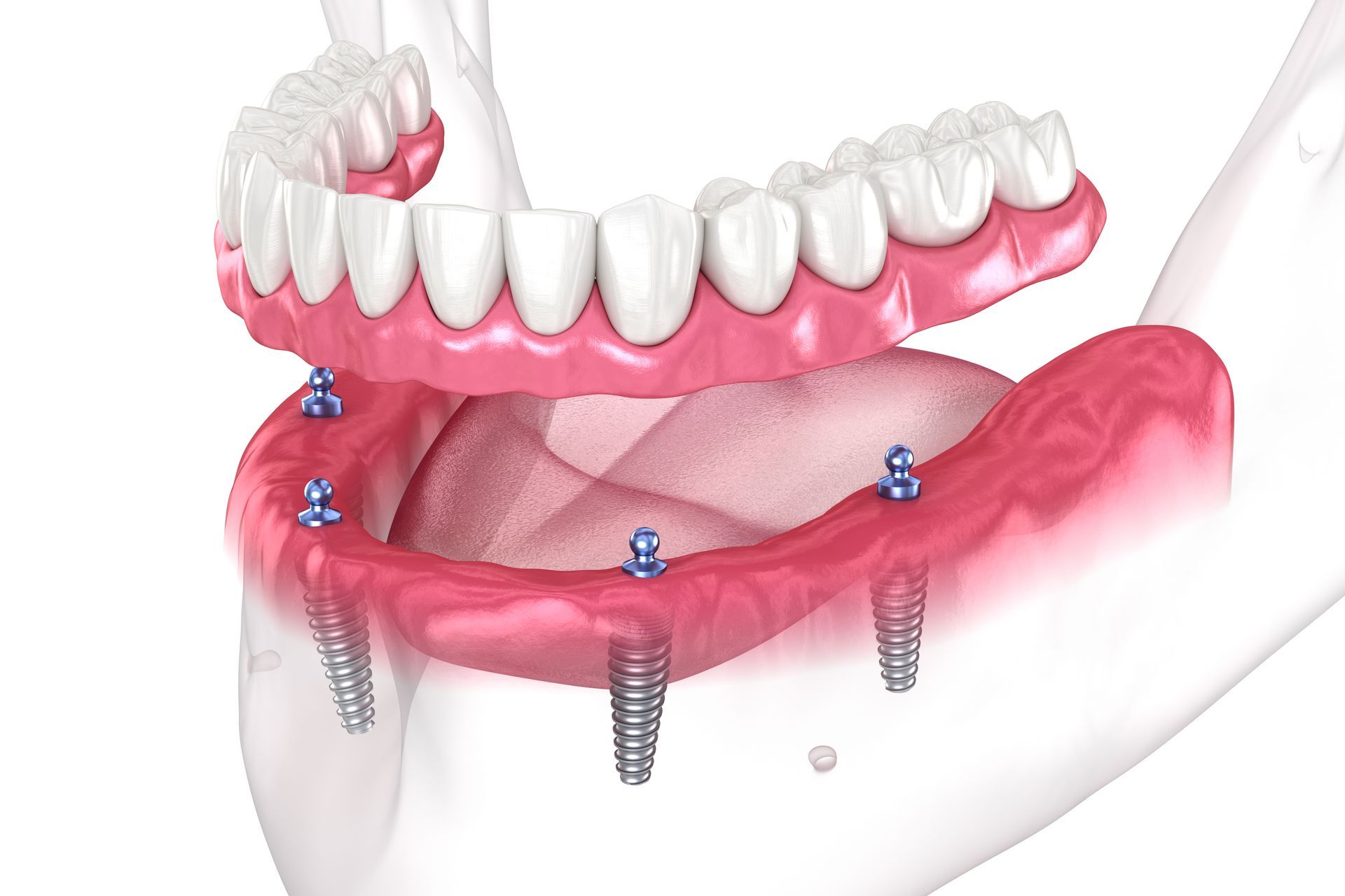 Implantes All on 4 são a solução ideal, e resultam mesmo em casos de falta de osso no maxilar.