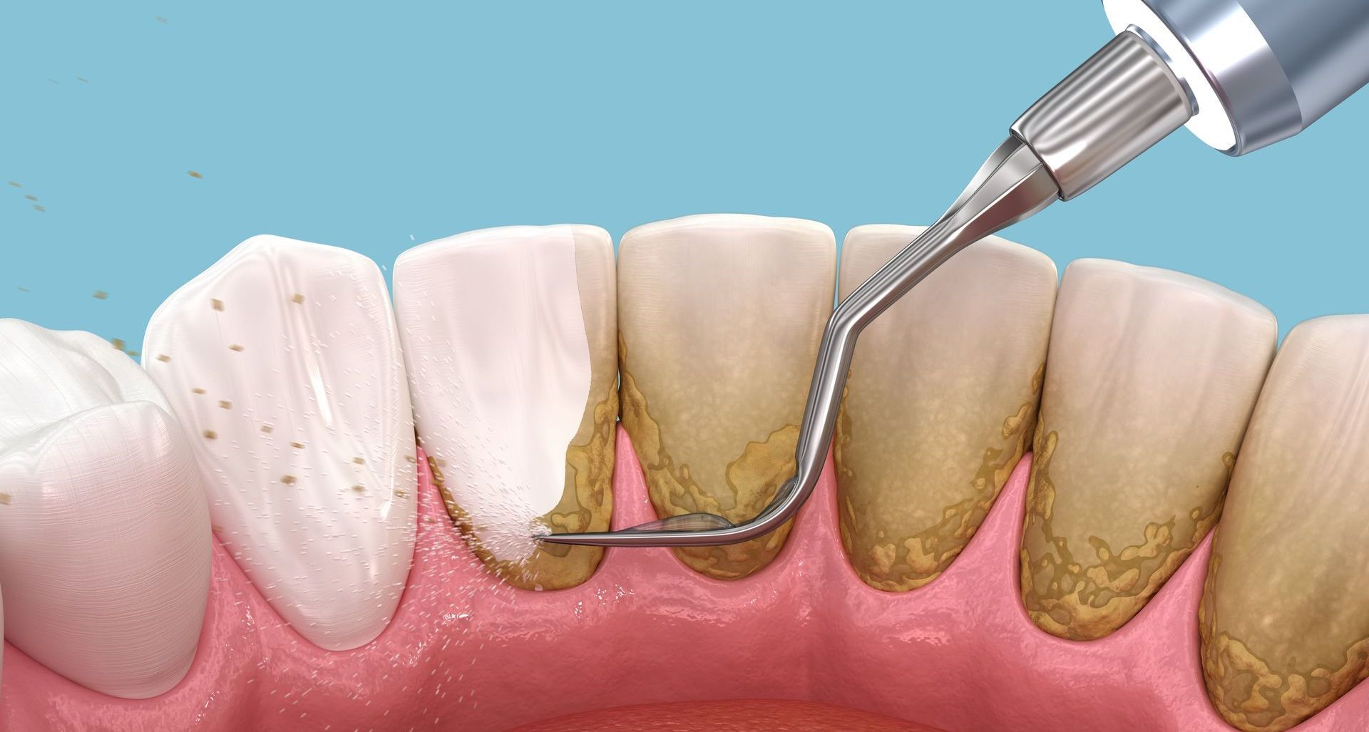 Remoção da placa dentária pelo higienista oral.