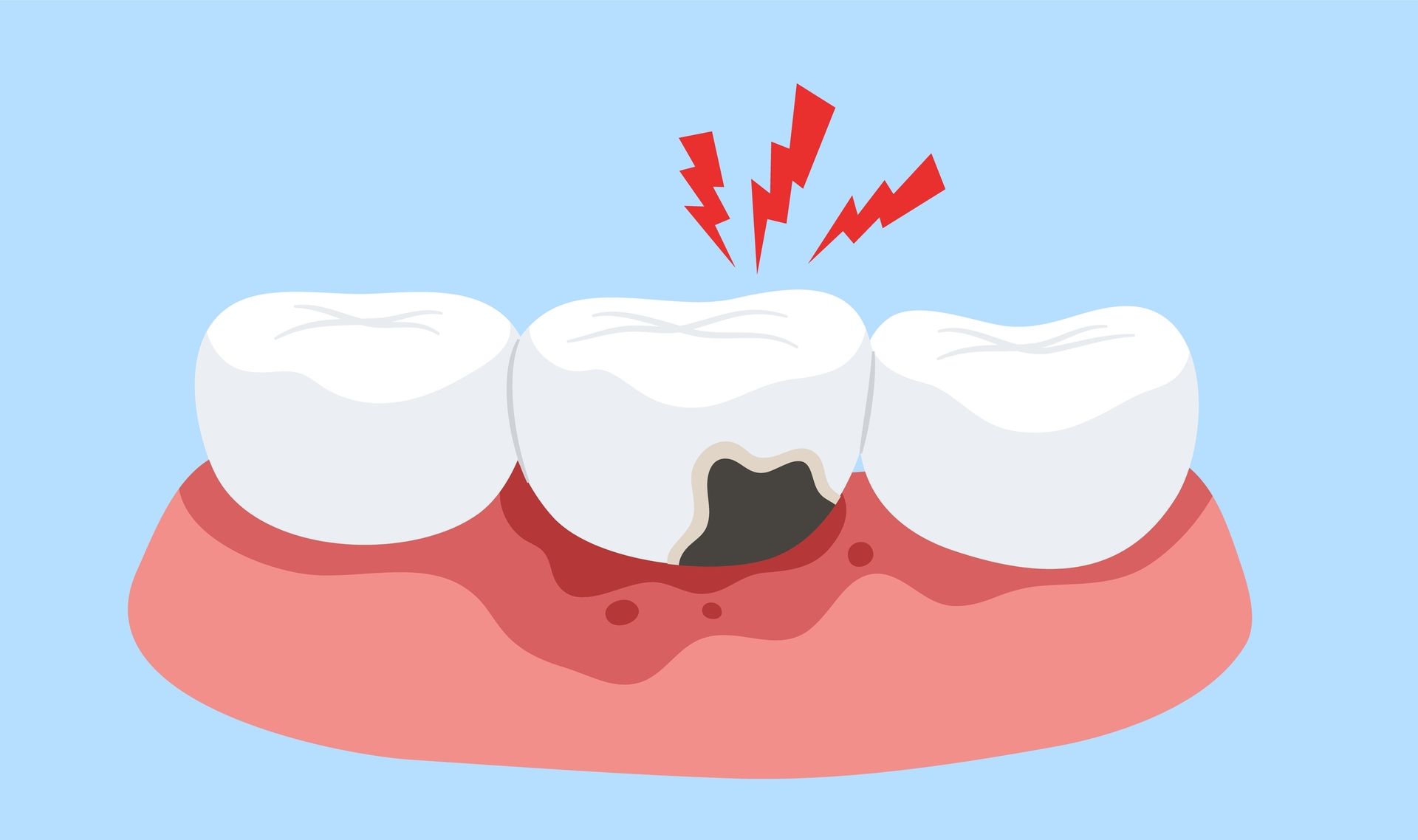 Cárie dentária originando dor e manchas nos dentes.