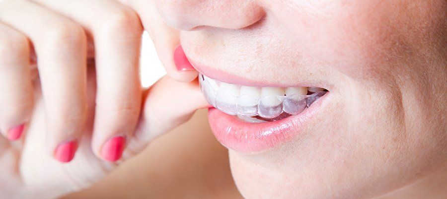 7 Invisalign Tips for a Seamless Experience