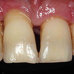 Periodontitis Tooth
