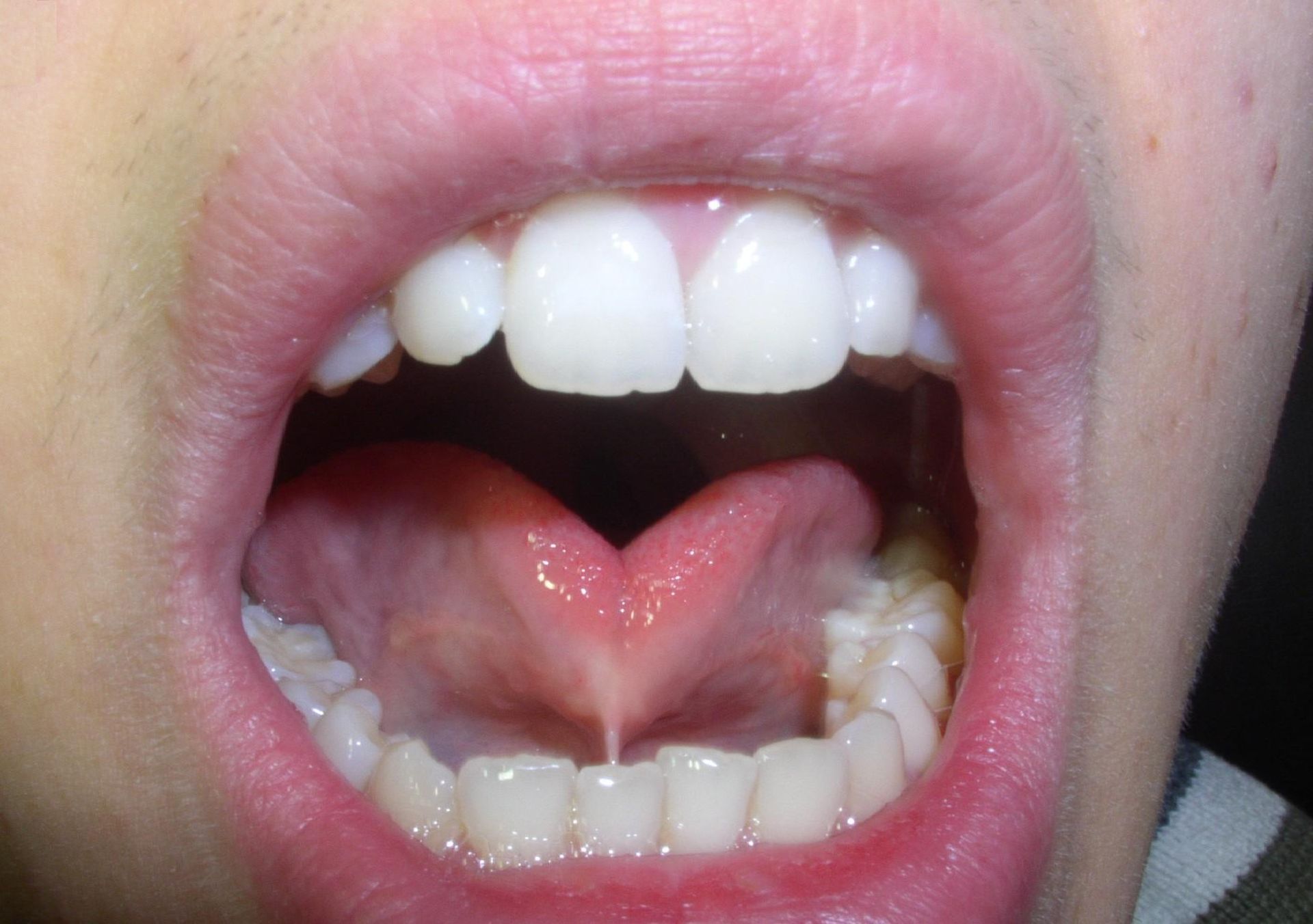 The Effects of Tongue Ties on Speech Everything You Should Know