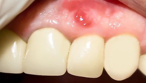 Soft Tissues Injuries in the Mouth