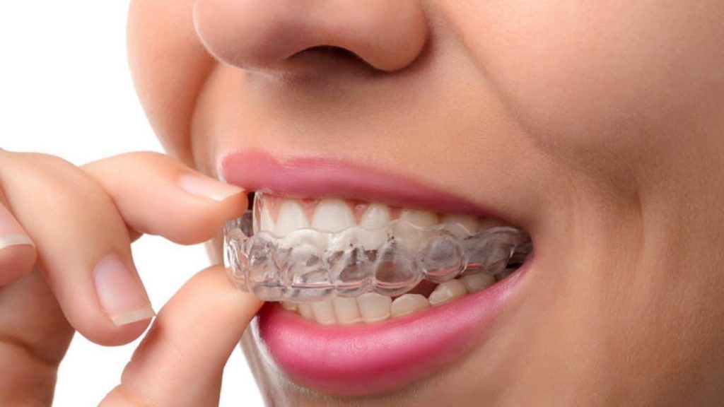 All You Need To Know About Invisalign Braces