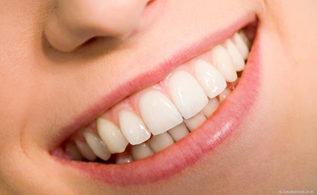 Veneers geben unschönen Zähnen wieder ein natürliches und ästhetisches Aussehen.