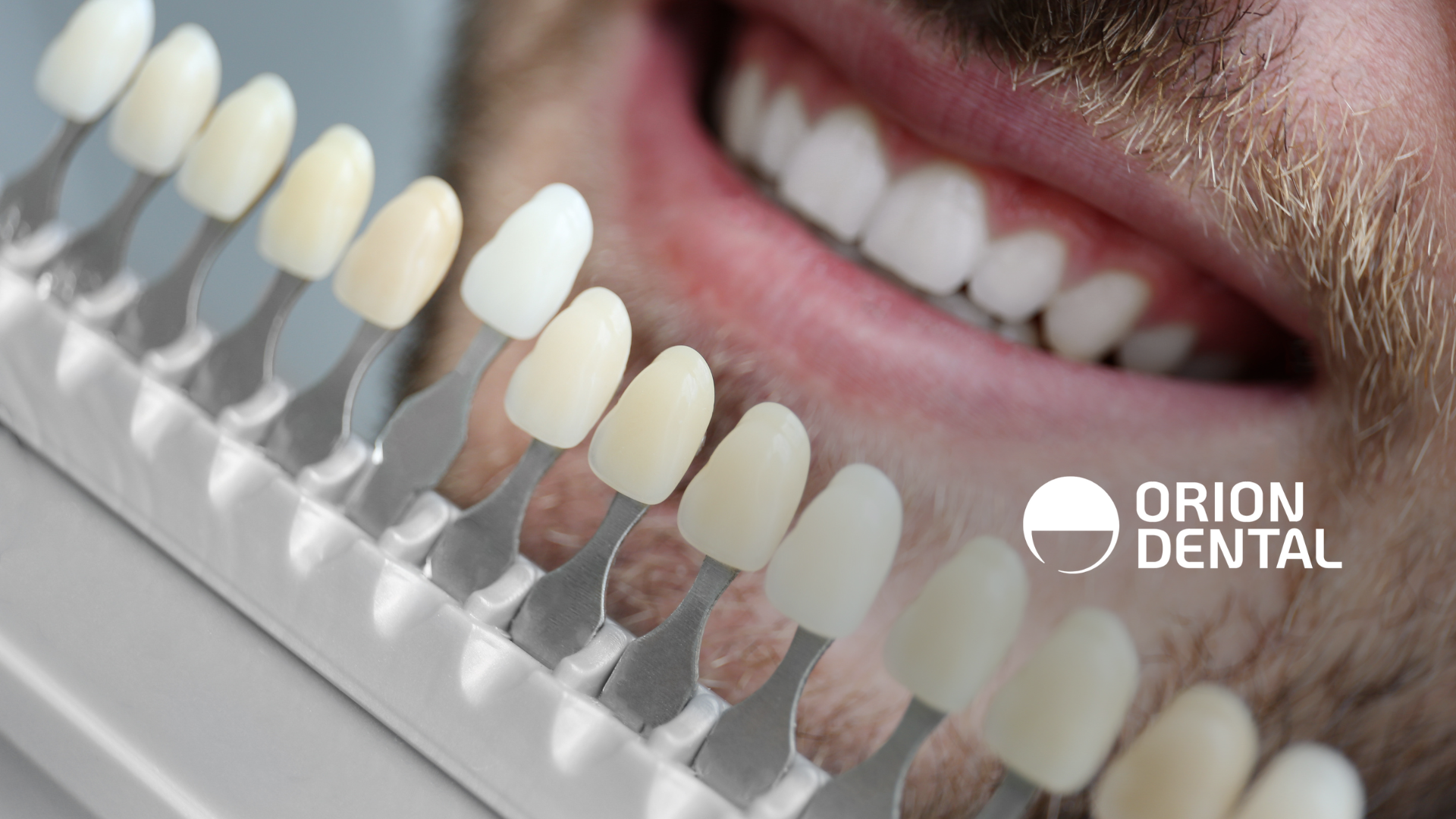 Teeth whitening comparison with shades next to smiling teeth.