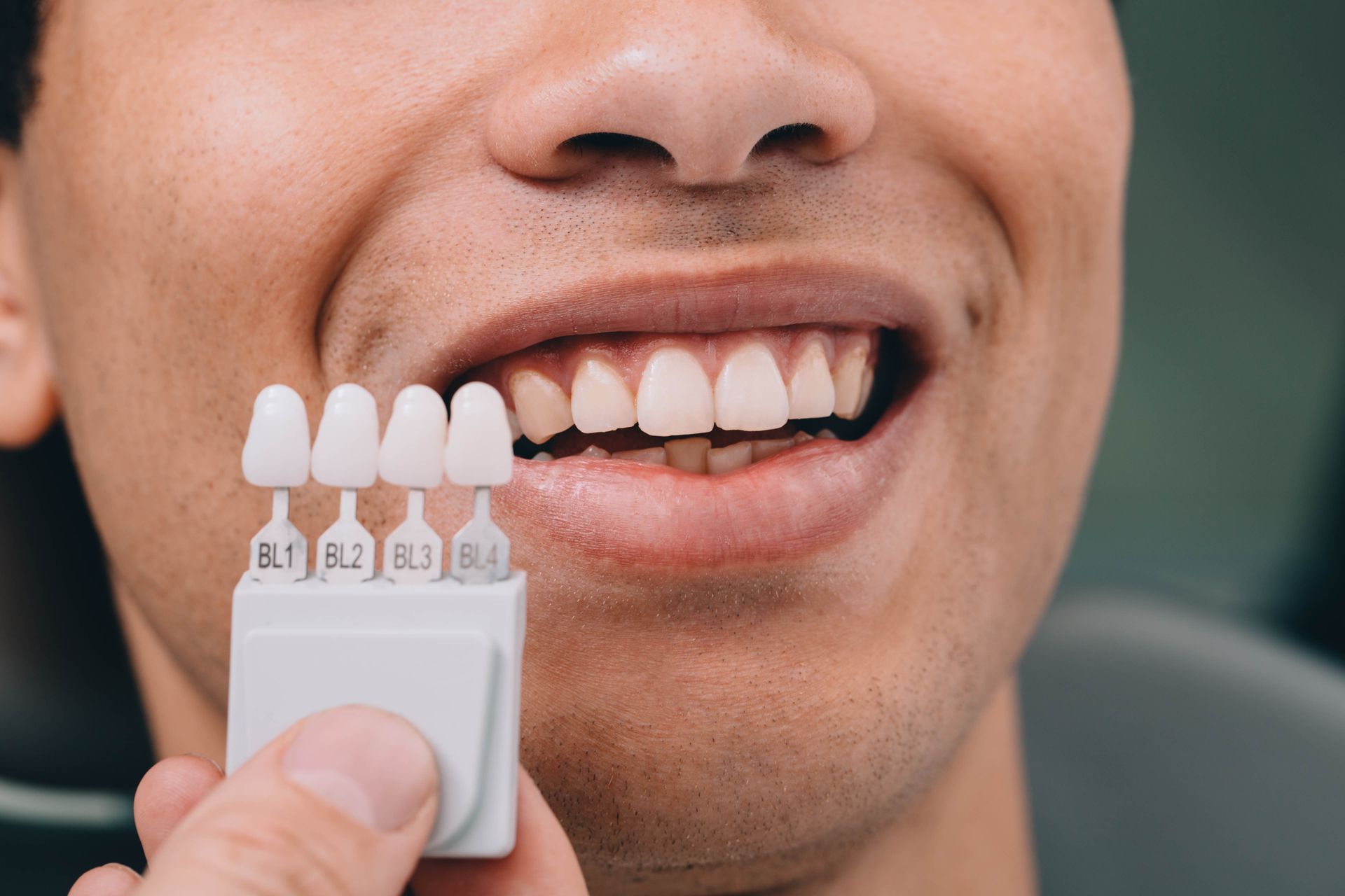 Person's teeth compared to white shade guide. Dentist's hand holds color tabs up to teeth in dental office.
