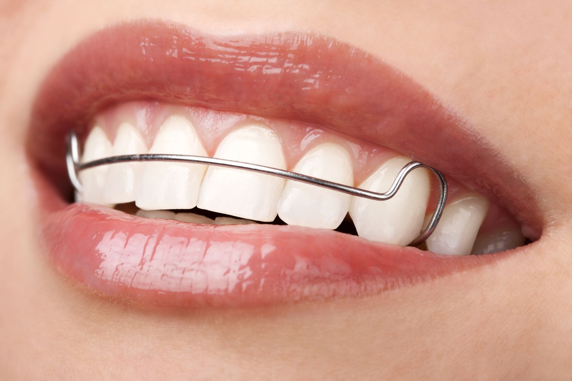 Close-up of a person's mouth with a silver, wire retainer on the upper teeth.