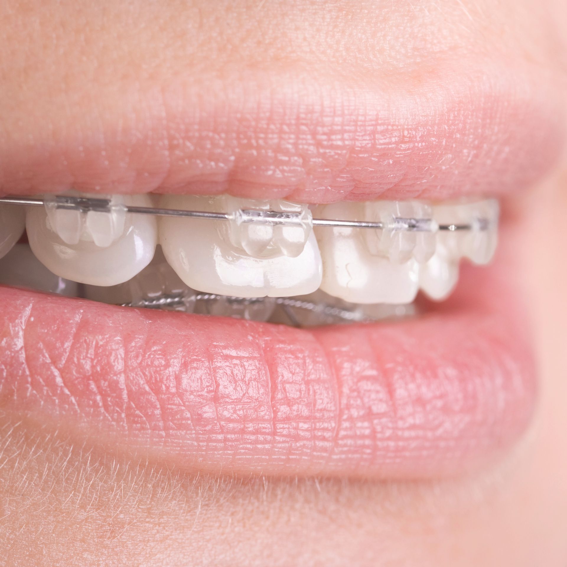 A close up of a woman 's mouth with braces on her teeth.