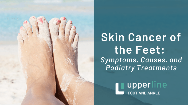 Skin cancer of the feet