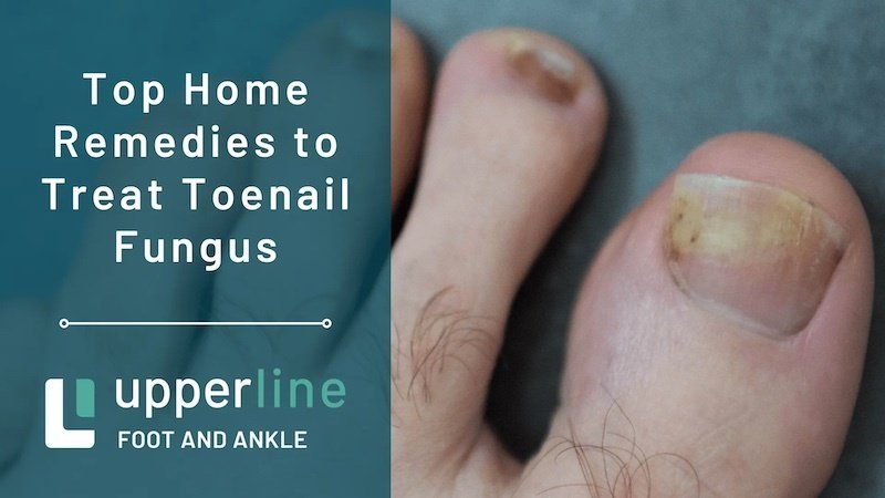 Home Remedies for Toenail Fungus