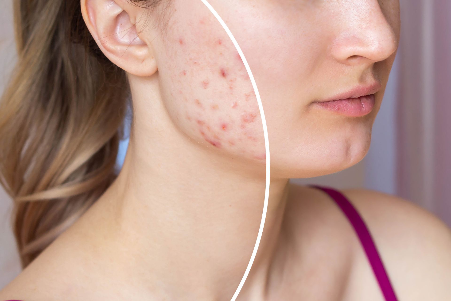 A before and after picture of a woman 's face with acne.