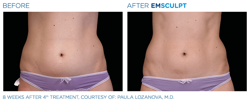 before and after results of Emsculpt machine treatment on abdominal muscles