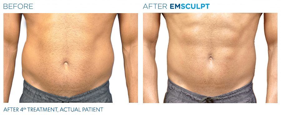 Man before and after Emsculpt machine treatment