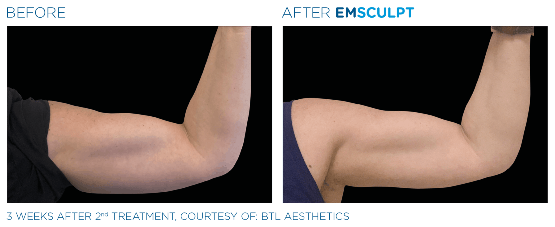 before and after results of Emsculpt machine treatments on arms