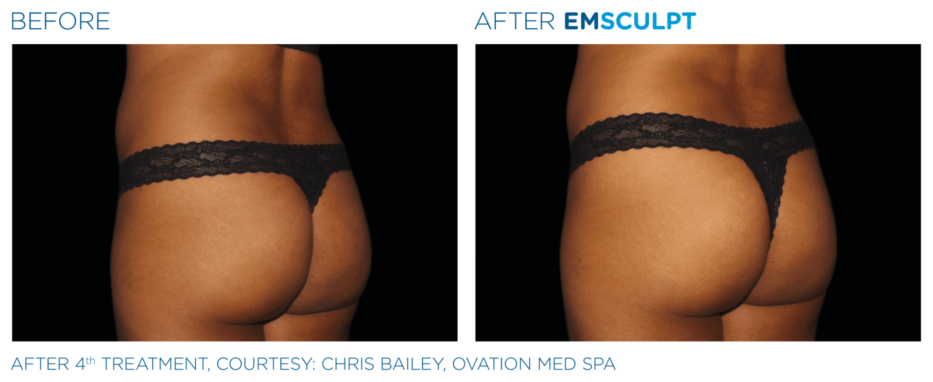 before and after of Emsculpt machine treatment on butt musclesment on