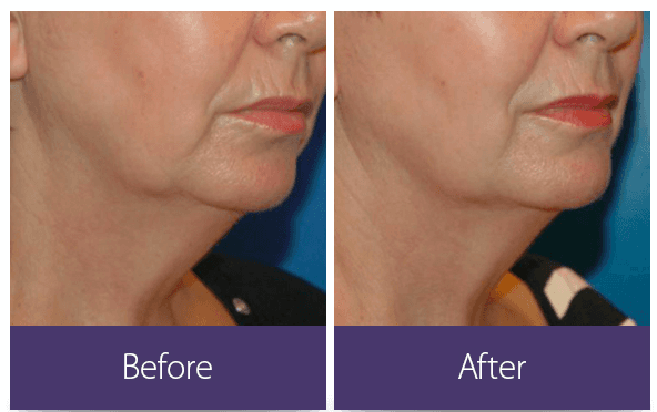 laser-fat-removal-walnut-creek-ca-lavoro-laser