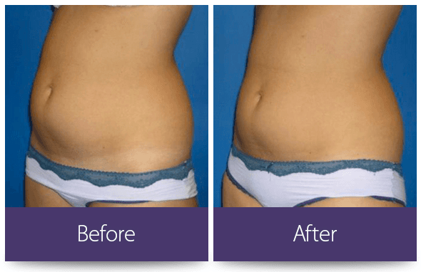 Before and after results of laser fat removal