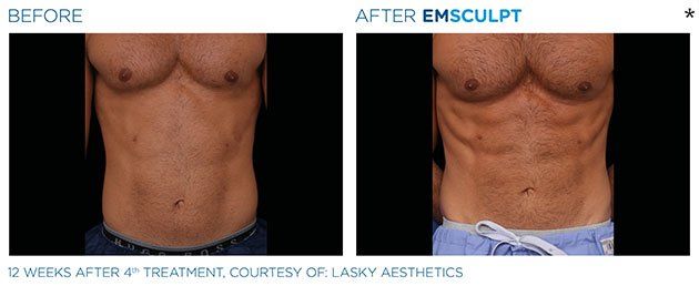 Before and after results of Emsculpt machine treatment