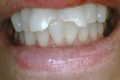 Before Treatment Restorative