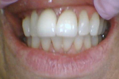 After Treatment Restorative