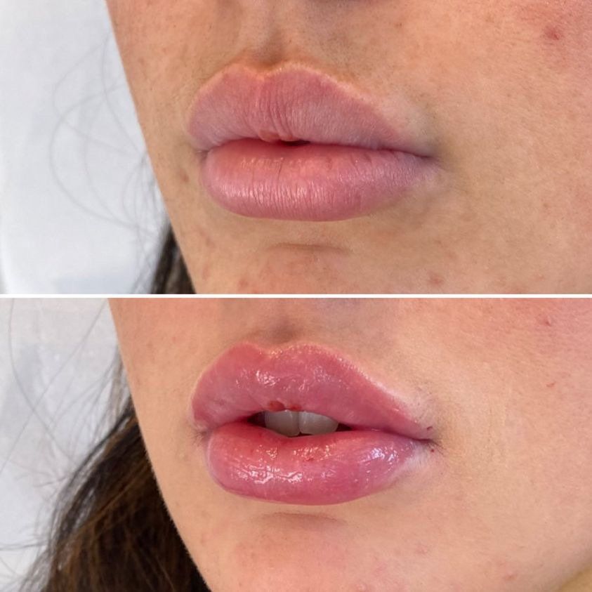 Cameo Clinic lip augmentation before & after